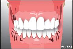 Les maladies des gencives