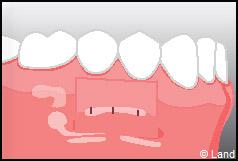Chirurgie mucogingivale
